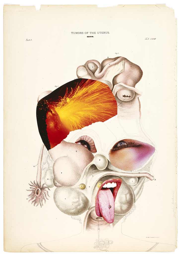 Tumors of the Uterus. 2005. collage on found medical illustration ...